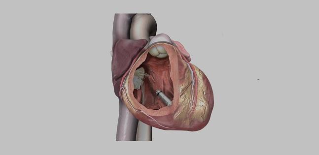 Micra Leadless Pacemaker Tied to Fewer Complications in Medicare Patients