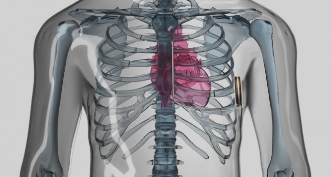 Subcutaneous ICD Holds Up Well Against Transvenous Devices