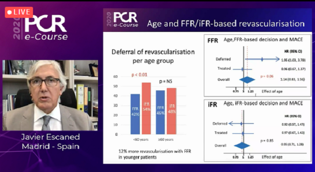 Age May Impact Outcomes After PCI Choices Guided by FFR but Not iFR