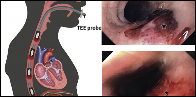 High TEE Injury Rate in Structural Heart Interventions Warrants Caution