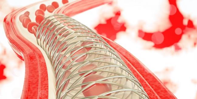Stent Thrombosis May Be Presenting Feature of COVID-19 