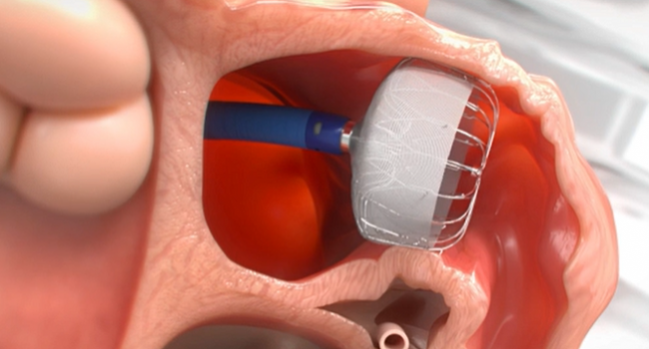 FDA Approves Next-Generation Watchman FLX Device for LAA Occlusion