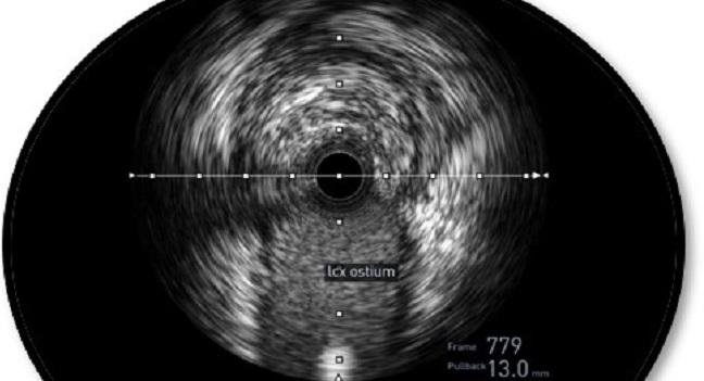 Better Outcomes, Including Mortality, With IVUS-Guided PCI: Medicare Analysis