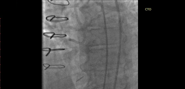 Operator, Hospital Experience Matter for CTO PCI Success
