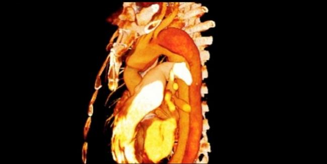 Unruptured Thoracic Aneurysm in TAVR Tied to Aortic Dissection, Cardiac Tamponade