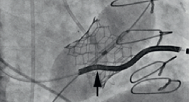 When a Pacemaker Lead Complicates Transcatheter Tricuspid Replacement: New Insights
