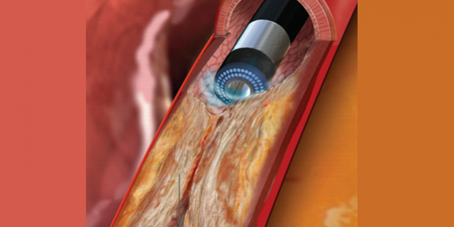 Large UK Study Explores Use of Excimer Laser Coronary Atherectomy 