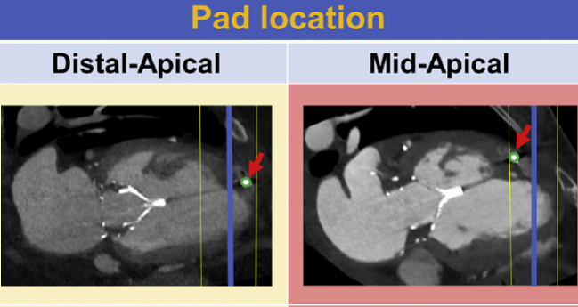 Implantation Technique Influences LV Remodeling After TMVR