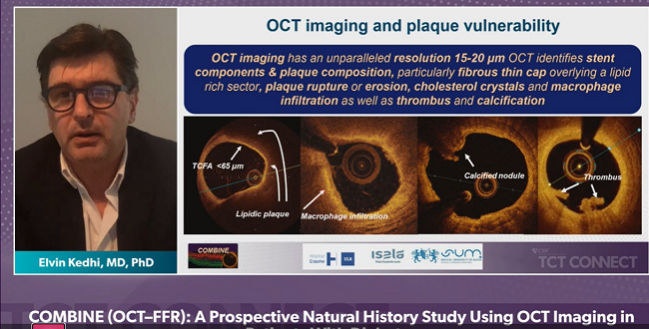 OCT Proves Predictive in Diabetic Patients, Even in FFR-Negative Lesions 