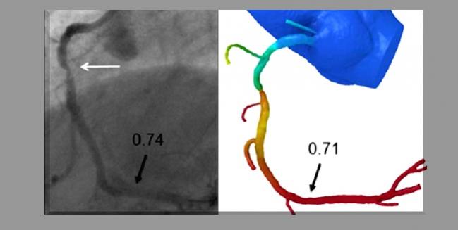 No Cost Savings With Routine FFRCT for New-Onset Chest Pain: FORECAST 