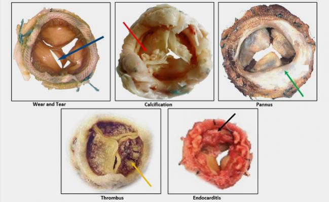 Encouraging Results Seen for TAVR in Failed Surgical or TAVR Valves