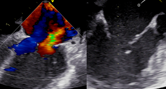 MitraClip Viable in MI Patients With Acute MR, Including Patients in Shock: IREMMI