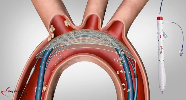 Efficacy Eludes TriGUARD 3 Cerebral Protection Device: REFLECT II