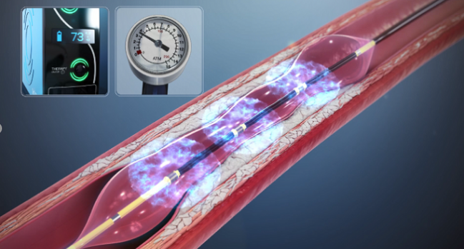 DISRUPT CAD III: Lithotripsy Boosts Stent Expansion in Highly Calcified Lesions