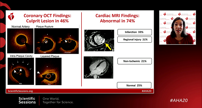 OCT and MRI Find an MI Cause in 85% of Women With MINOCA: HARP