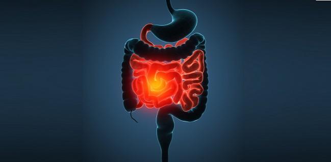 Increased ASCVD Risk With Inflammatory Bowel Disease Merits Team-Based Care