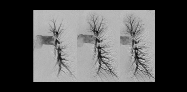 EXTRACT-PE: Positive Results With Aspiration Thrombectomy for Submassive PE