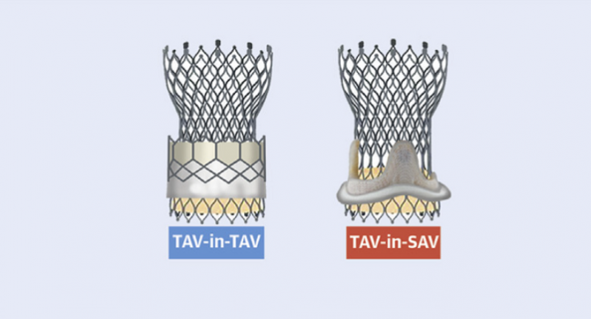 TAVR Yields Similar Success in Failed TAVR or Surgical Valves