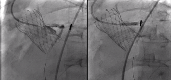 Unplanned PCI Rare After TAVI, but Operators Get Good Results