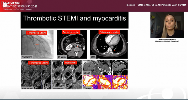 Assessing Myocardial Damage in COVID-19: The Role of CMR