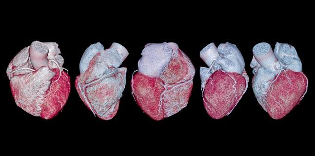 CTA Matches Invasive Angiography for Stratification of NSTE ACS Risk