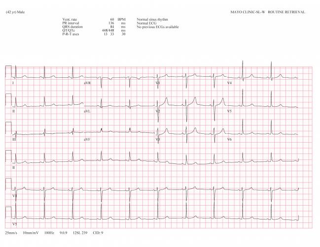 Machine Learning ‘Sniffs’ Out Long QT Otherwise Unseen on ECG 