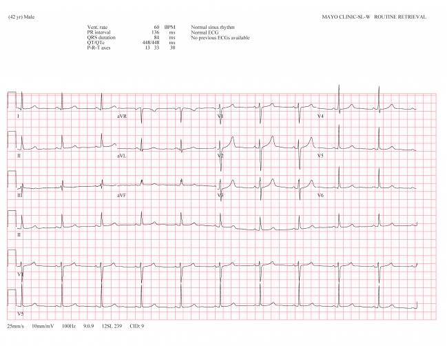 Early CVD Detection with BPM & ECG