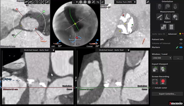 Low Mortality and Stroke Rates With BASILICA Pre-TAVI, Registry Shows