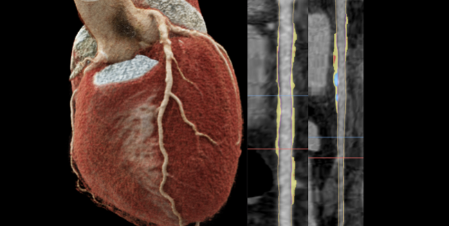 Gatekeeper CTA Strategy in Stable Chest Pain Still Needs Honing