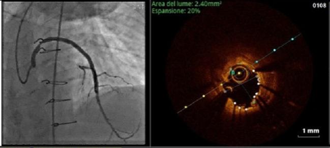 ‘Aggressive’ OCT Strategy for Stent Sizing Noninferior to IVUS: iSIGHT