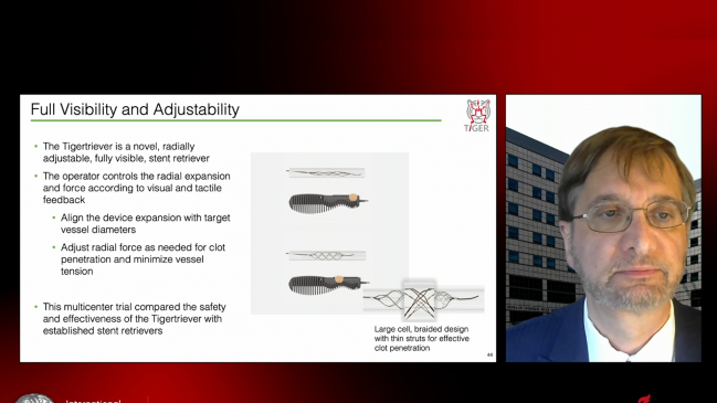 Adjustable Stent Retriever Performs Well in IDE Trial