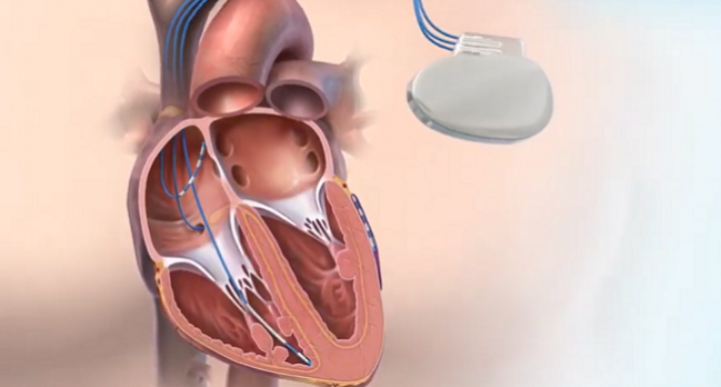 Novel MultiPulse Therapy for Terminating AF Passes Feasibility Hurdle