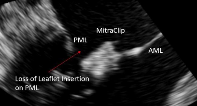 For Failed MitraClip, Next Procedure Might Depend on MR Etiology