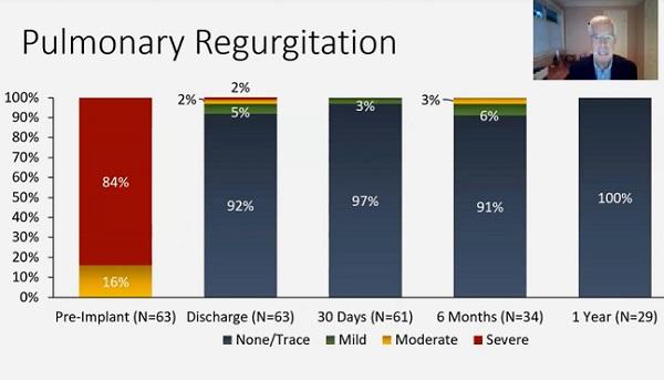 Harmony TPV Continues to Reduce Pulmonary Valve Regurgitation at 1 Year