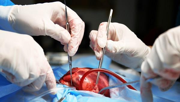 Occluding the LAA During Surgery Lowers Stroke Risk: LAAOS III
