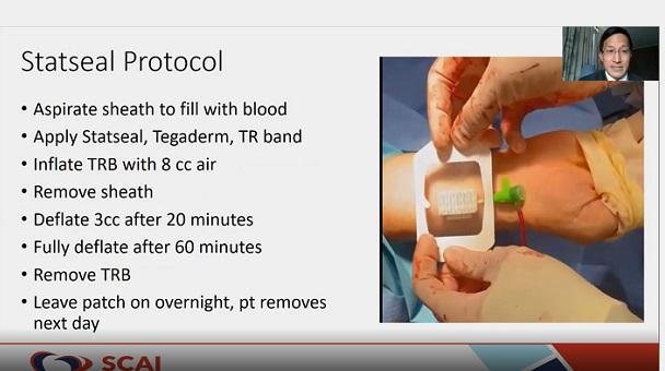 Compression Times Cut With Adjunctive Hemostatic Patch After Transradial Procedures 