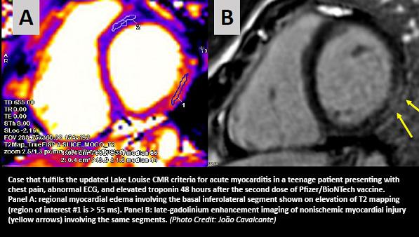 More Evidence Links Myocarditis to mRNA COVID-19 Vaccines