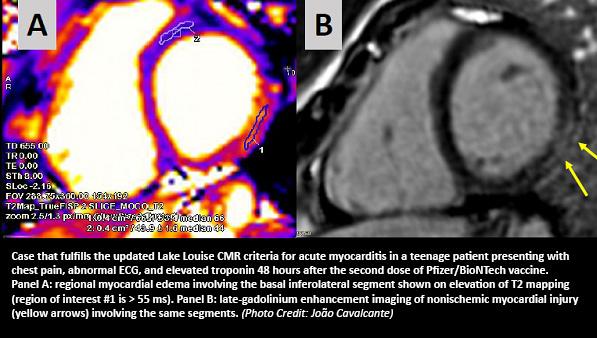 More Evidence Links Myocarditis to mRNA COVID-19 Vaccines 