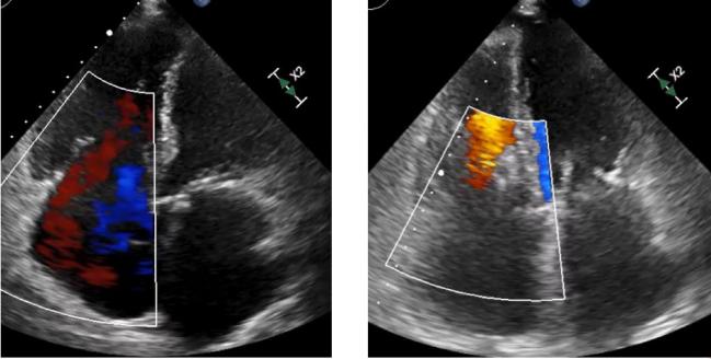 Pascal Device Works Well for Tricuspid Regurgitation in Commercial Market