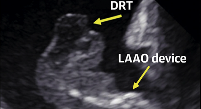 Predictors of Device-Related Thrombus Following Percutaneous Left