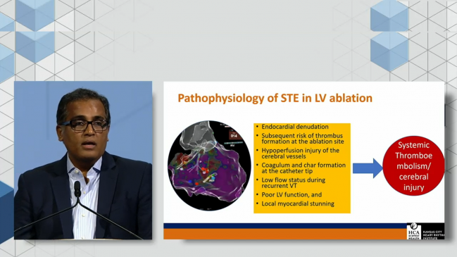 STROKE-VT: DOACs Cut Cerebrovascular Events After LV Arrhythmia Ablation