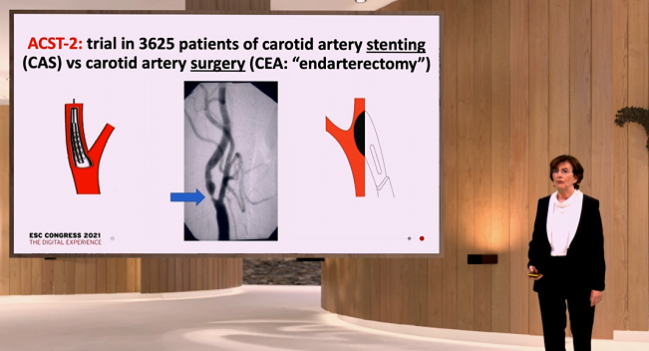 ACST-2: Carotid Stenting, Surgery Provide Similar Outcomes in Asymptomatic Patients