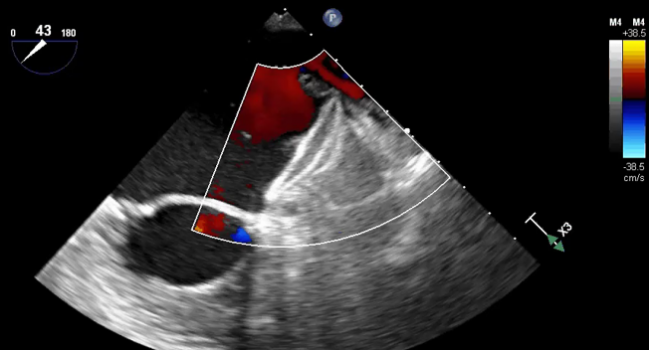 FDA Approves Amplatzer Amulet LAA Occluder