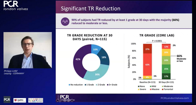 Promising Early Results for TriClip in Tricuspid Regurgitation: bRIGHT Registry