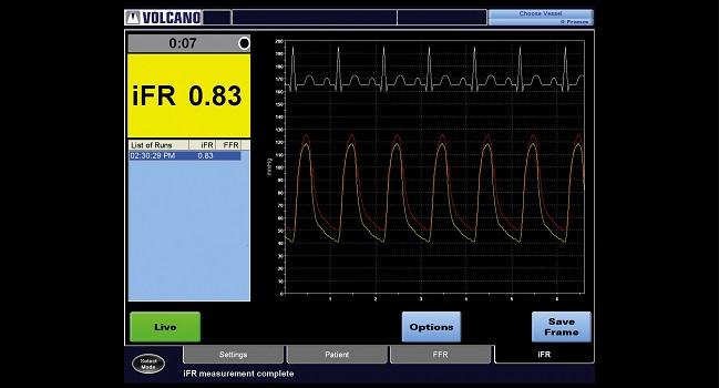 iFR Matches FFR Through 5 Years: iFR-SWEDEHEART