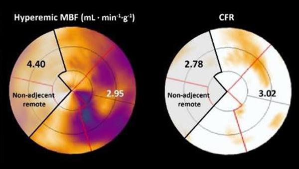 CTO PCI Improves Total Myocardial Viability, PET Imaging Suggests 