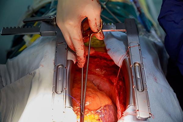 Using Donor Hearts After Circulatory Death Is Feasible for Transplantation 