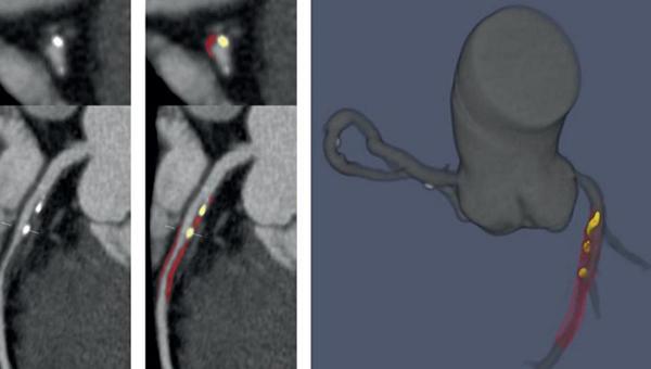 Deep-Learning Tool Can Gauge Plaque Burden, Stenosis Severity on CCTA 