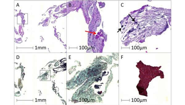 Embolic Protection Snags Debris in Nearly All Lower-Risk TAVI Patients