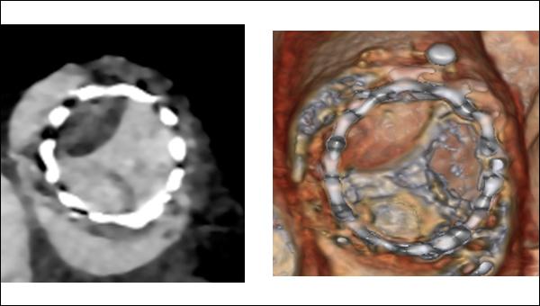 Subclinical Leaflet Thrombosis After TAVI Linked to Higher Mortality